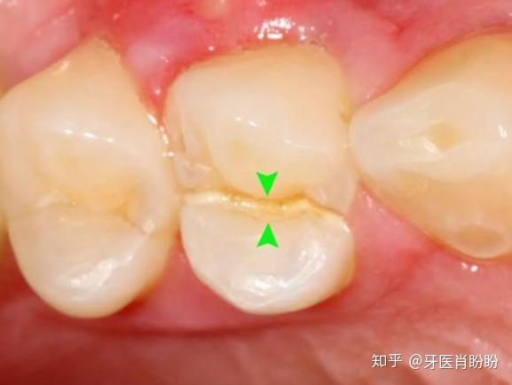 沒有蛀牙牙卻很痛醫生多半是牙齒折裂了初期治療很重要