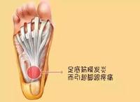 足底筋膜炎可以自愈吗
