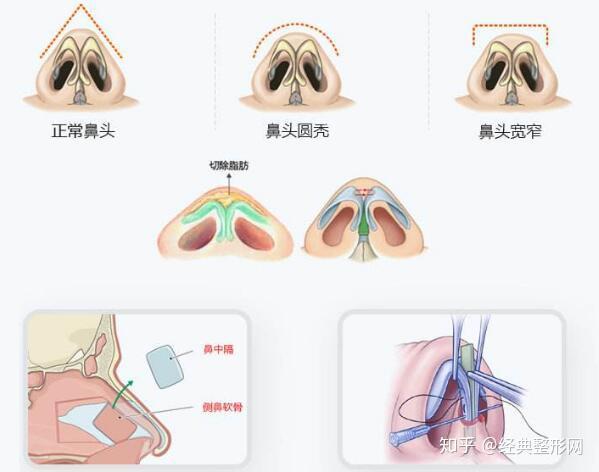 并且改善鼻子的高度,宽度,翘度,整体弧度 适合人群:鼻基础底子差