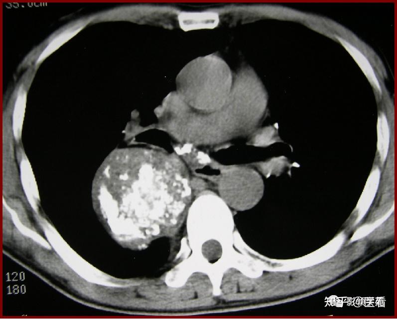 肺良性肿瘤影像表现
