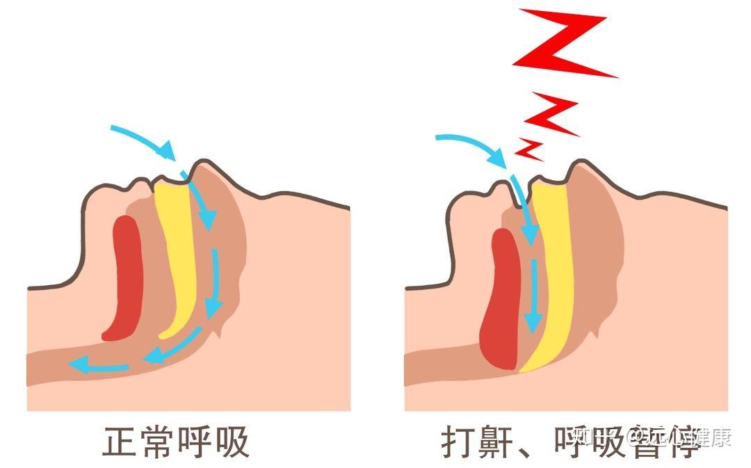 爱打鼾的人背后藏着心脏什么隐患
