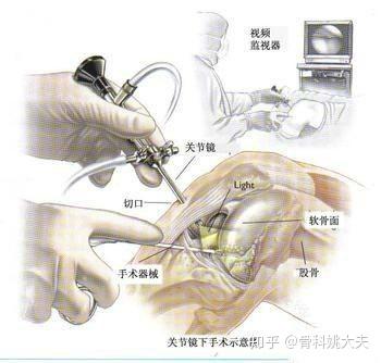 半月板损伤会产生哪些后遗症 知乎 半月板损伤会产生哪些后遗症 知乎
