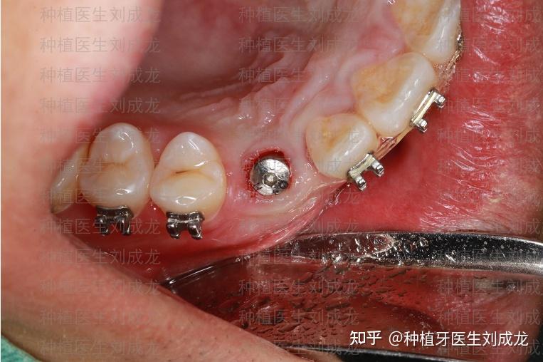 郑州种植牙|乳牙滞留 即拔即种 种植案例 - 知乎