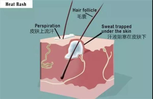 寶寶出汗太多以至於不能用蒸發排出,汗液滯留,造成了皮膚汗腺毛孔堵塞