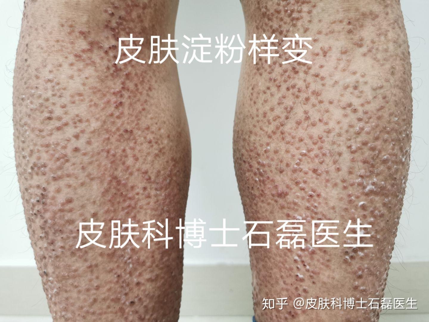 原发性皮肤淀粉样变表现