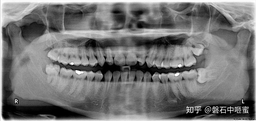 上第三磨牙图片