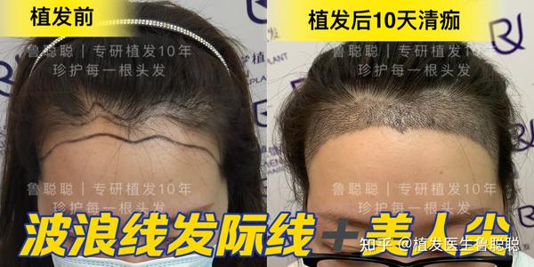 5大发际线样式,你的脸型适合哪个? - 知乎