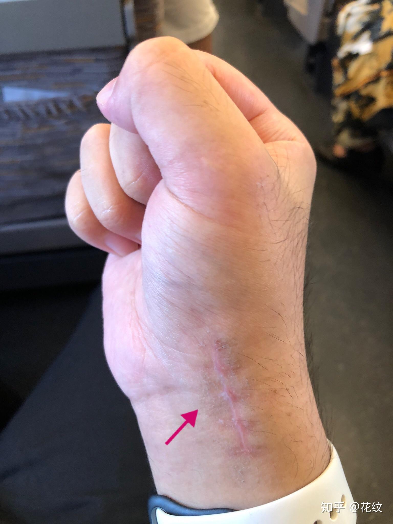 10月13日:手可以用力握拳,大拇手指剧烈活动根部有点疼,手腕有限位