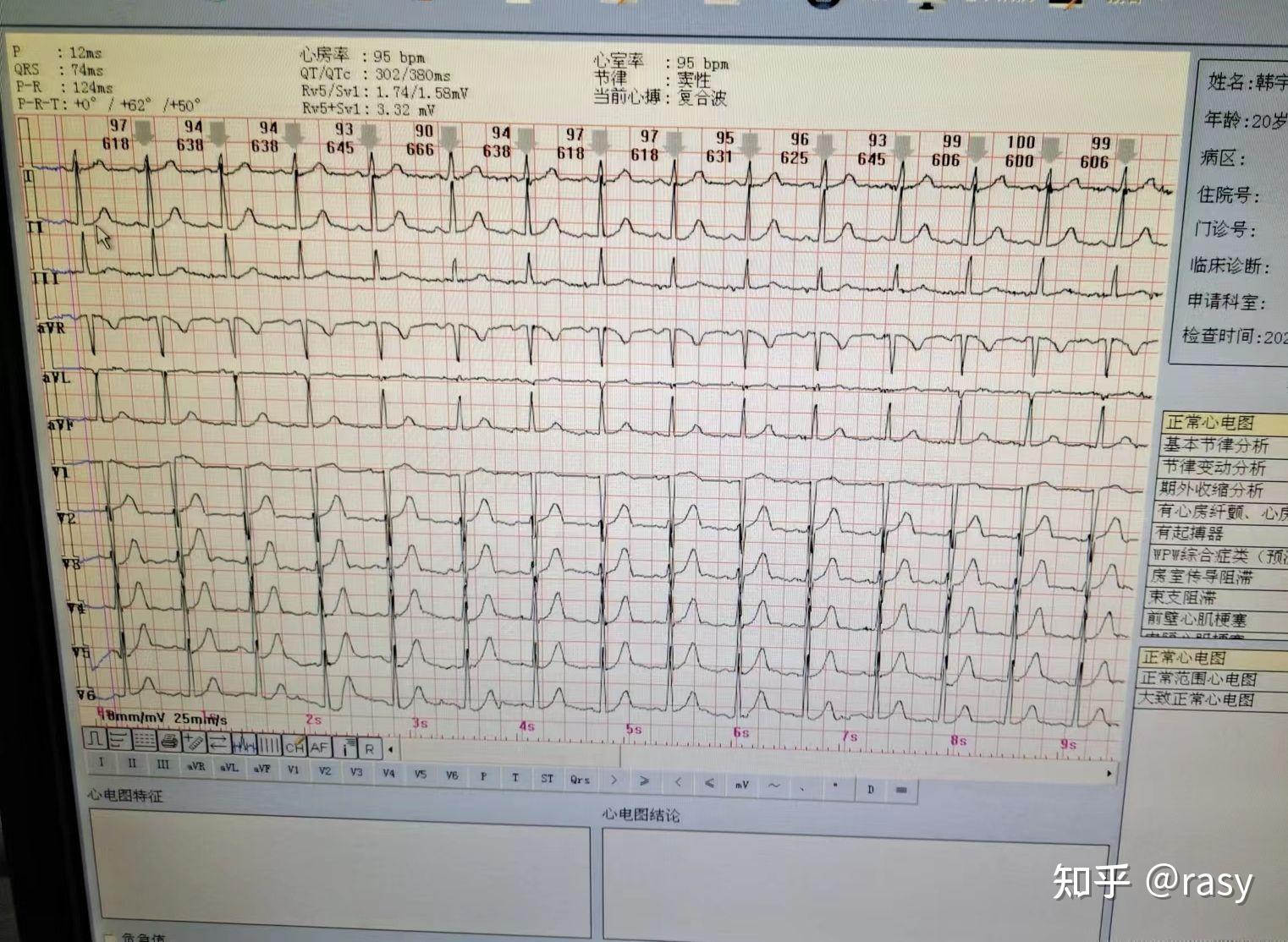 谢谢啦大一要写实验报告医学生求问这个心电图结论应该怎么下1 人赞同