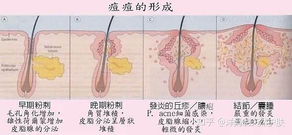 發炎的痘痘已經損傷到真皮層,使皮膚嚴重受損,潰爛,一定會留下痘坑.