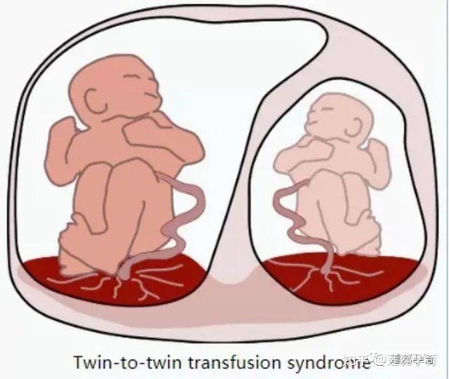 多胎妊娠是喜是忧