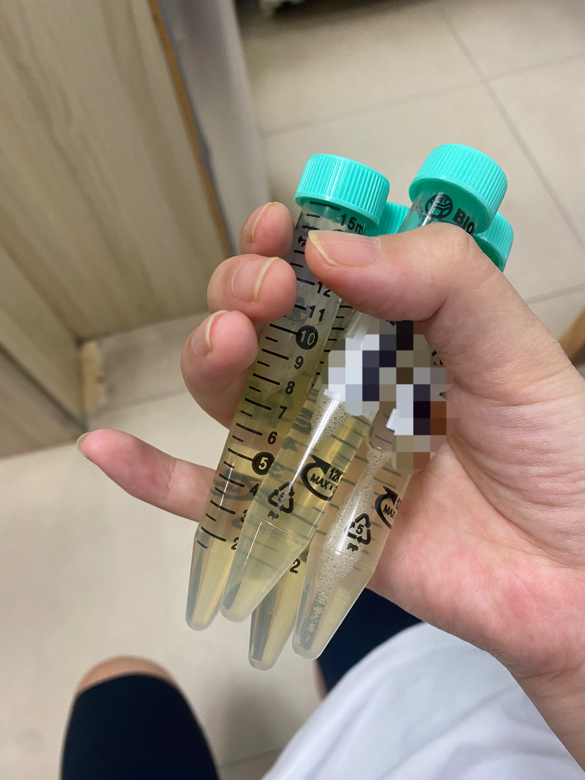 记录:羊水穿刺 - 知乎