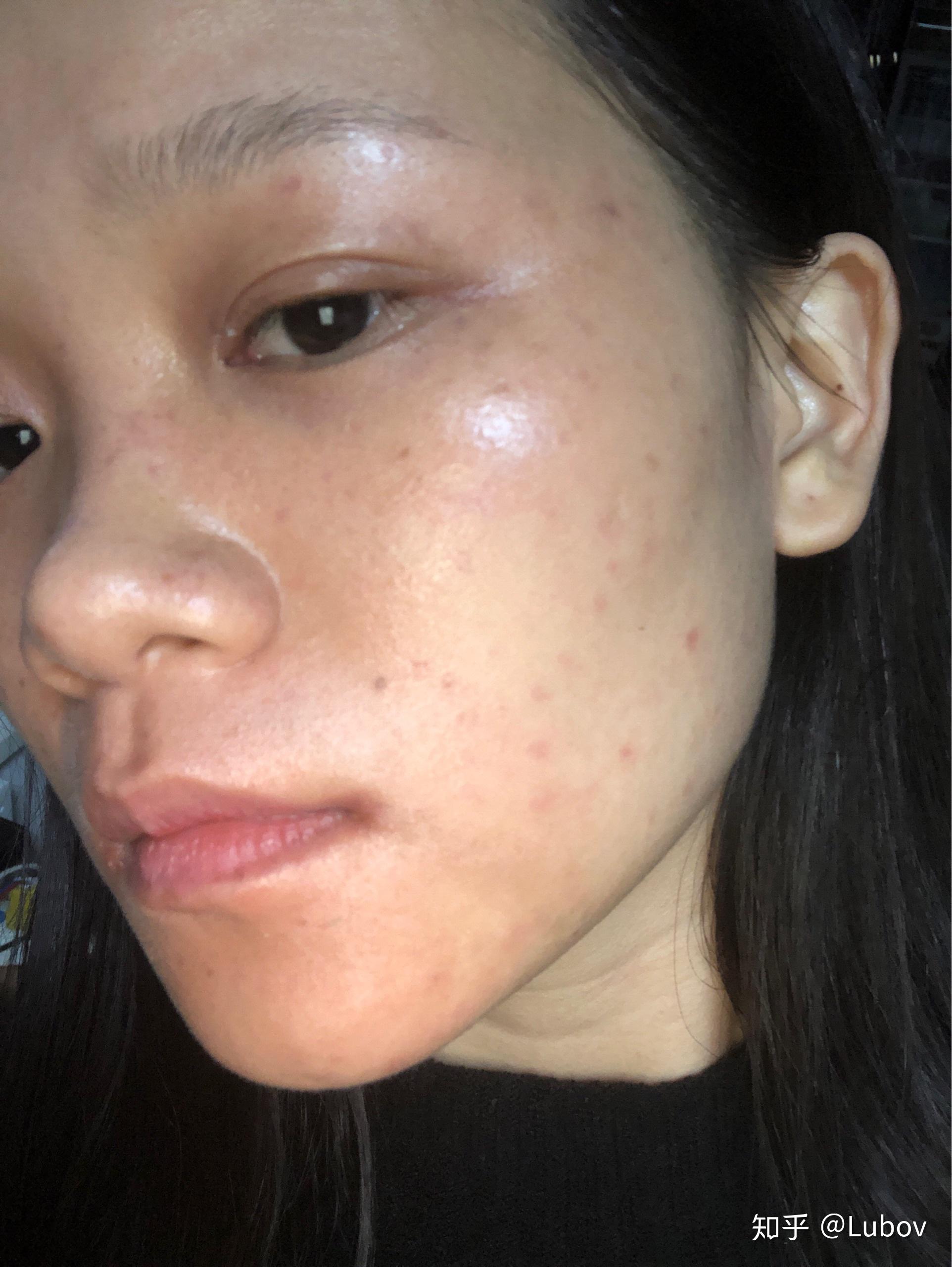 祛斑提取后美容院说要用他家产品一年感觉要吃土了