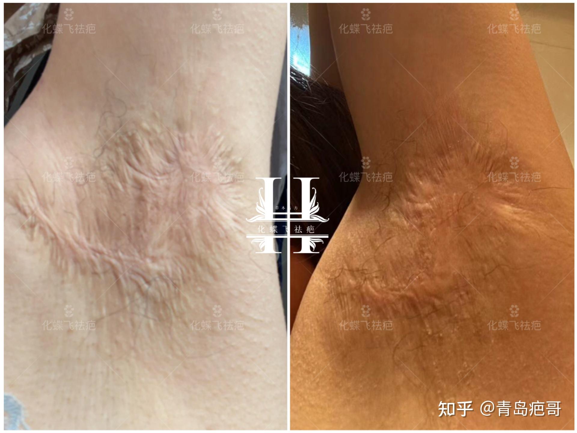 二十多年的腋下手术疤痕