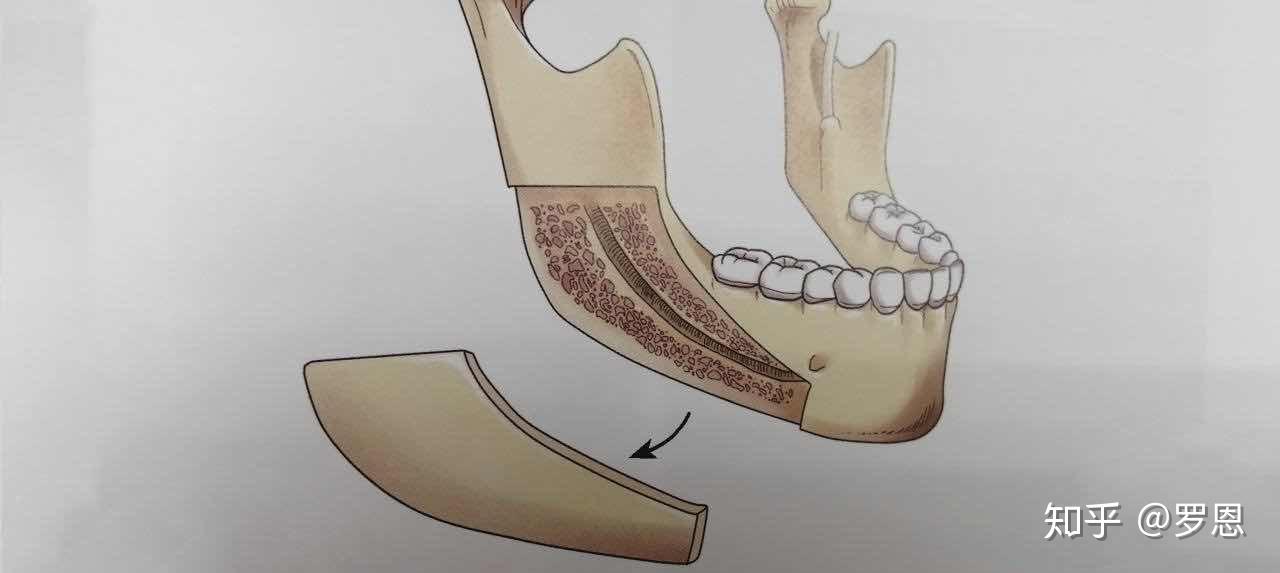 下颌角外板劈除术