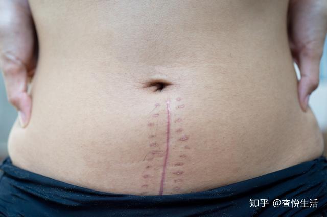 剖宫产中横切口和竖切口有什么区别？哪个更利于产妇恢复 - 知乎
