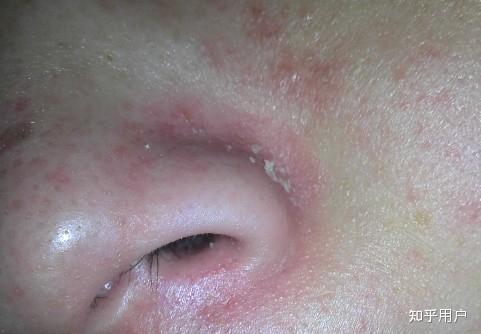 鼻子有黑头而且还发红有时候怎么办？