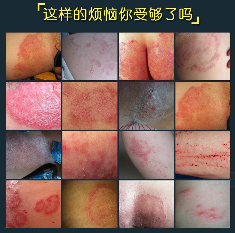 大腿内侧瘙痒是股癣还是湿疹该如何护理呢 知乎