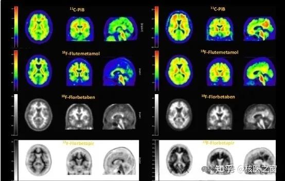 透视大脑Aβ沉积：Aβ PET/CT成像技术开启阿尔茨海默病诊断新视界 - 知乎