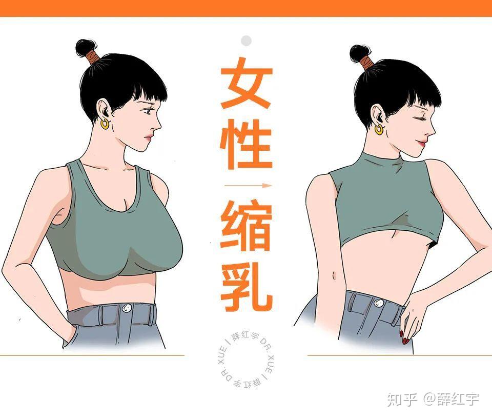 大胸福音乳房縮小巨乳縮小的可行性方案