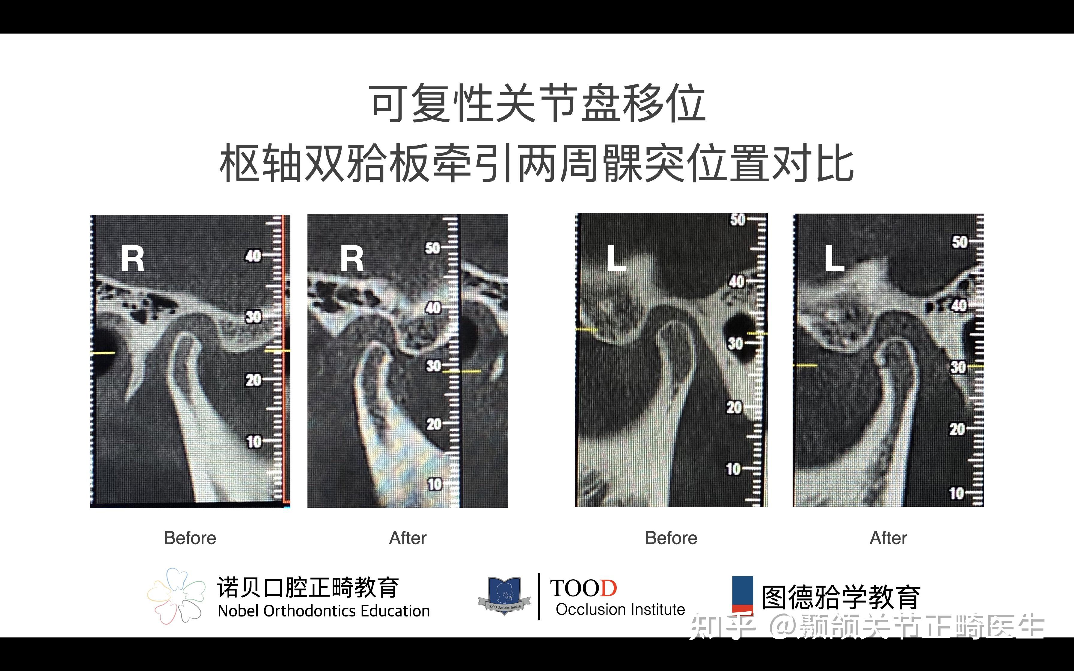 耳前區不適顳下頜關節彈響