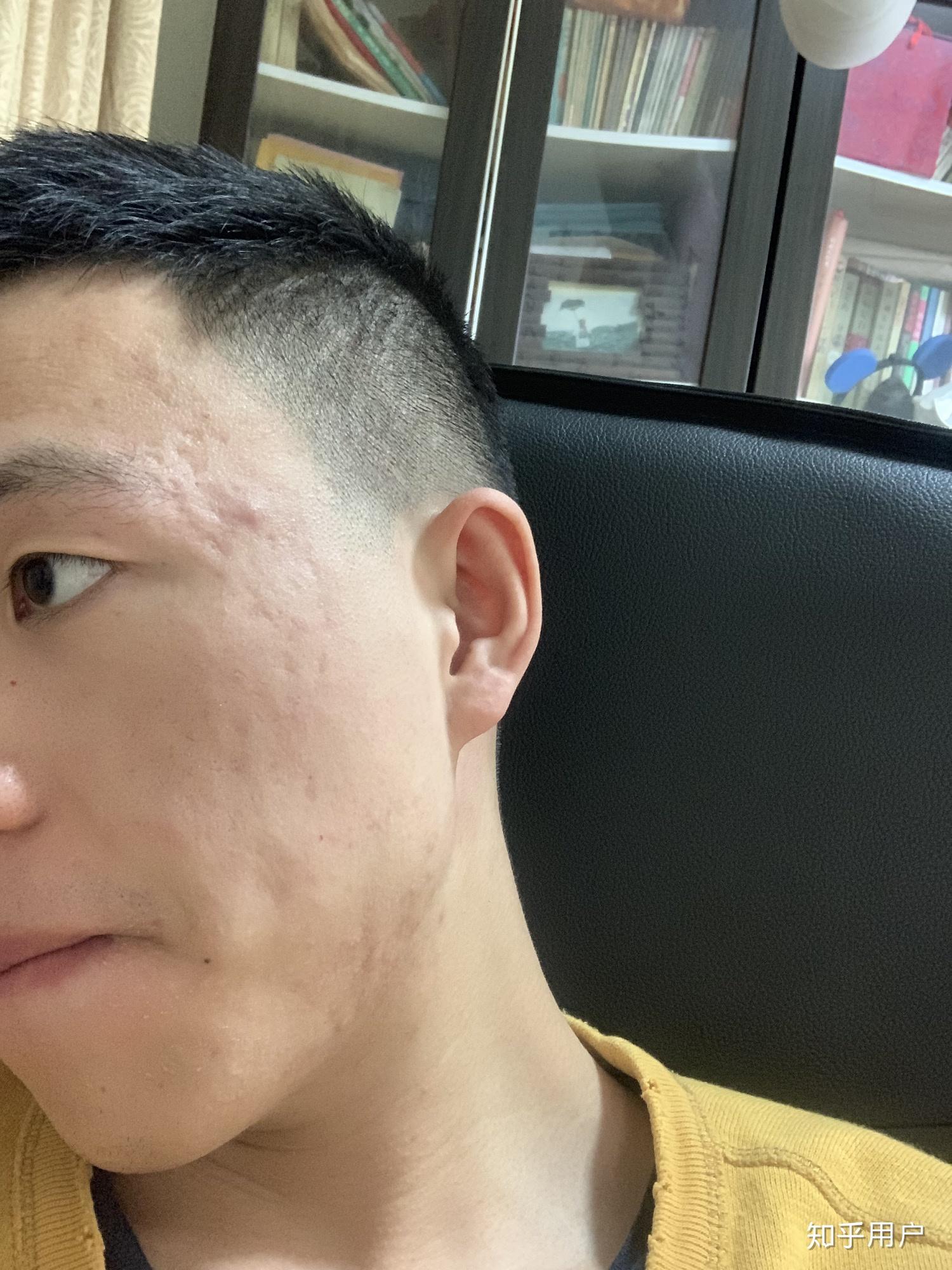 粉刺是什么样的一个状态 v2-f56cb9c1e7e9f2d3208c43e97769b023_r.jpg