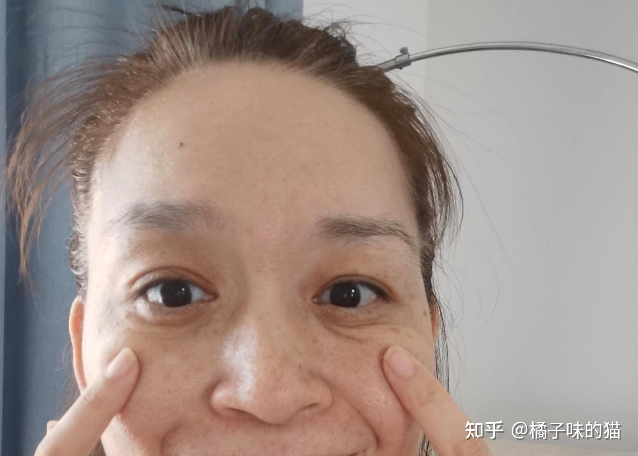 水肿型眼袋脂肪型眼袋松弛型眼袋好吧,咱们一个个说吧~●水肿型眼袋