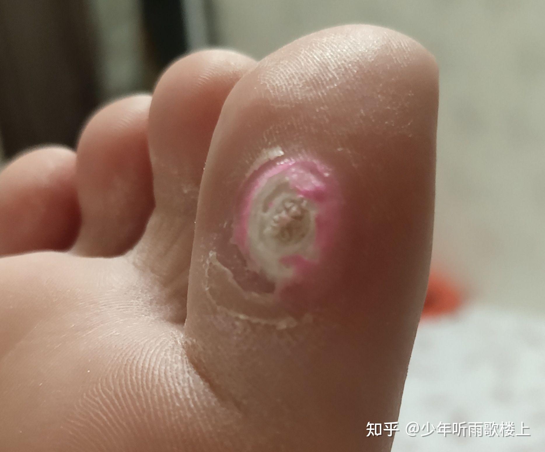 跖疣好了用的碘伏泡脚大法