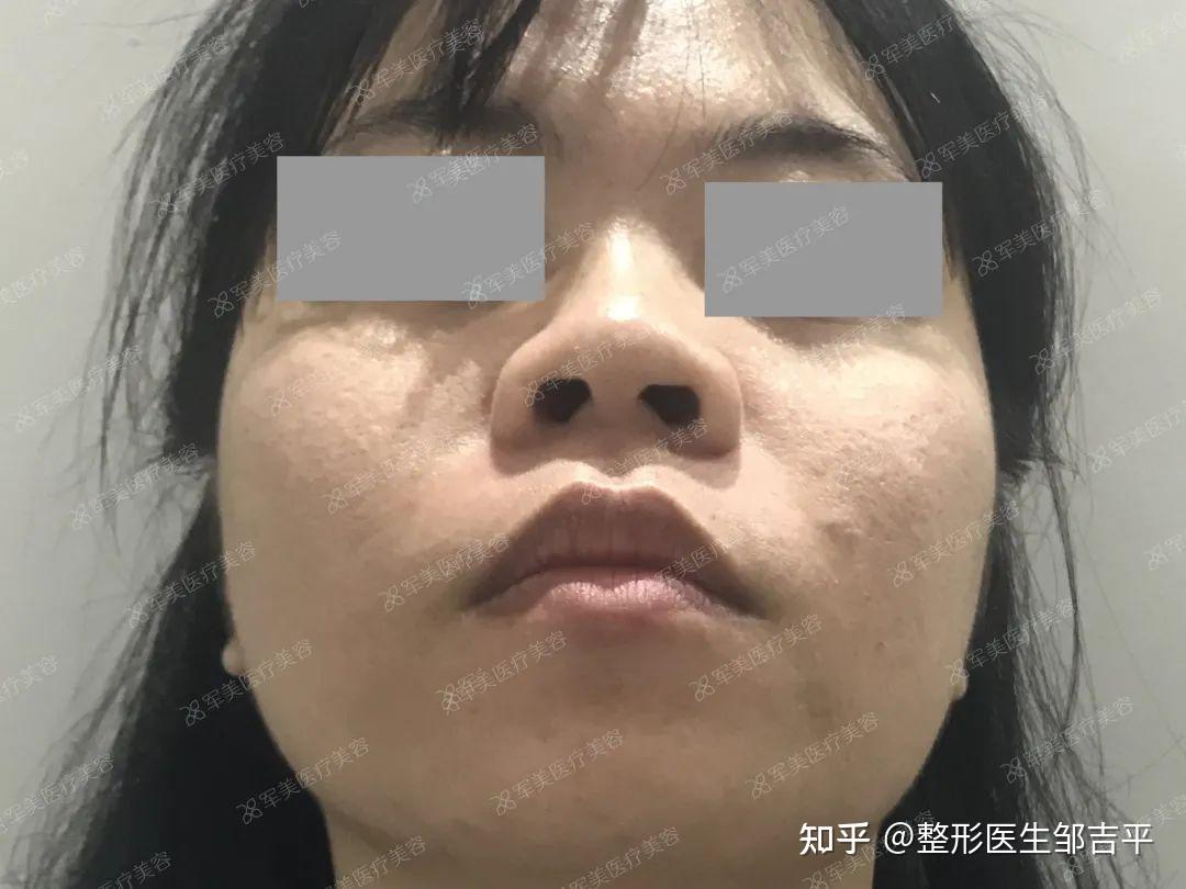 但是对于女生来说,漂亮的鼻子鼻梁骨都比较窄,没有向两侧突出,所以