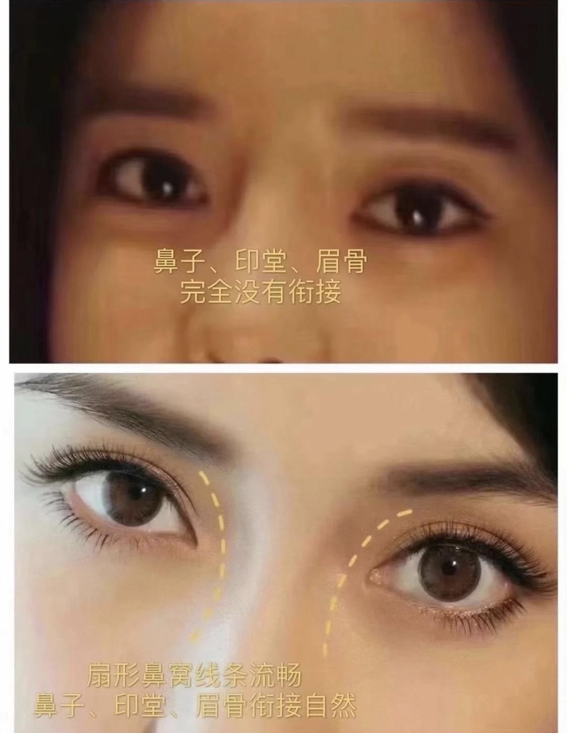 隆鼻耳软骨放哪个位置_隆鼻耳软骨隆鼻_隆鼻耳软骨会被吸收吗
