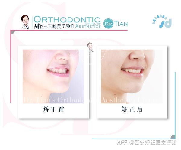 笑起来不好看？如何通过矫正获得适合自己的笑线 |西安牙齿矫正曹甜科普 - 知乎