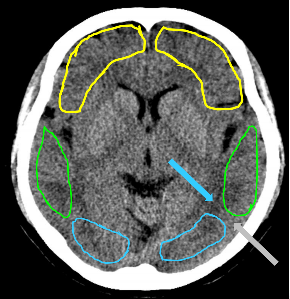 颞叶钩回疝ct图片图片