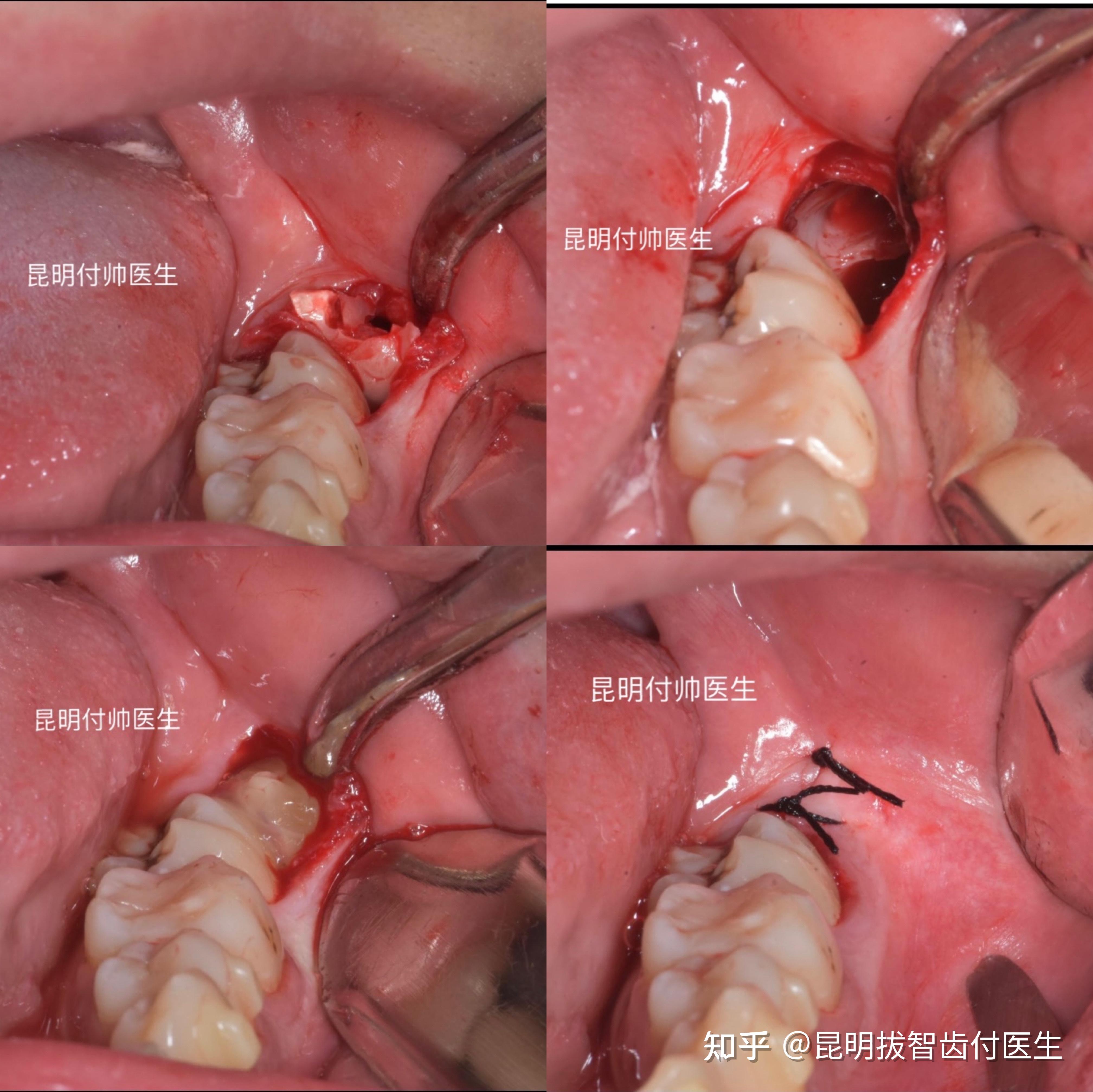 付醫生上半年接診過一個患者,兩年前在其他地方使用超聲骨刀拔智齒