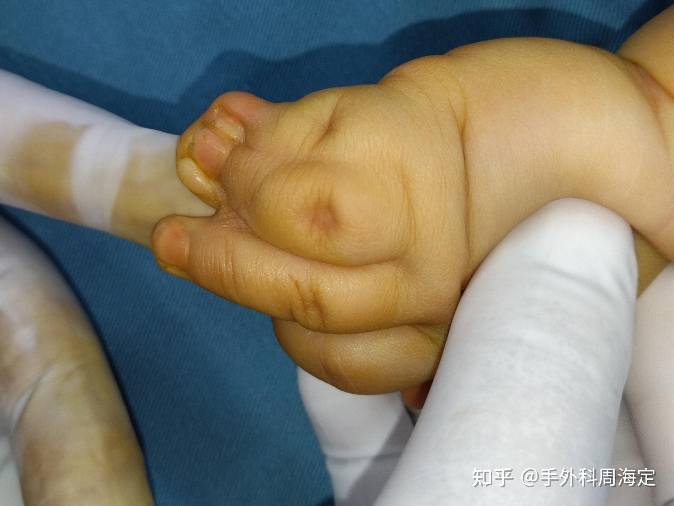 孩子不完全的并指畸形需要手术吗?