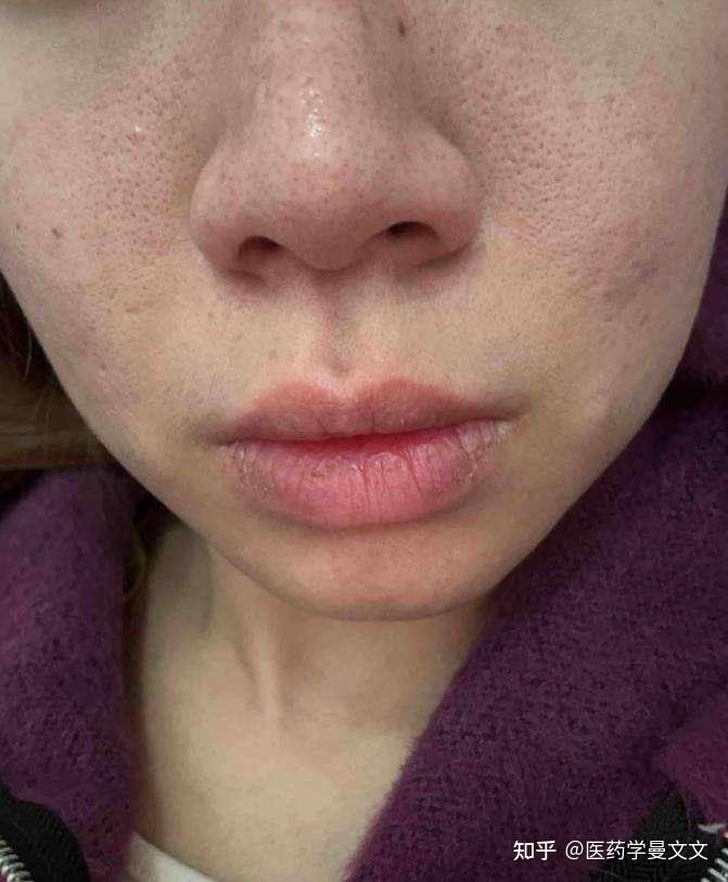 女生脸上毛孔粗大怎么办?去医院也不管用吗?【皮肤科医生】3步拯救粗大毛孔,还你细腻皮肤! - 知乎