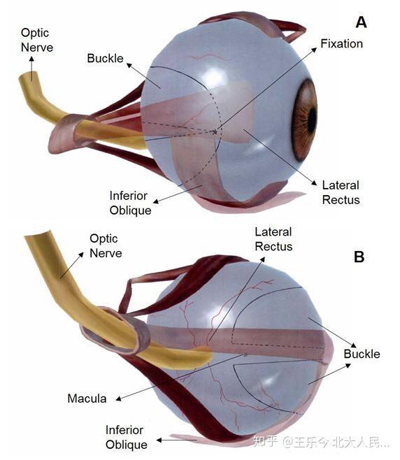 王乐今:后巩膜加固术治疗儿童高度近视 - 知乎