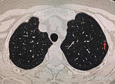 求心理陰影面積複查ct時竟然連肺結節數目都搞不清了