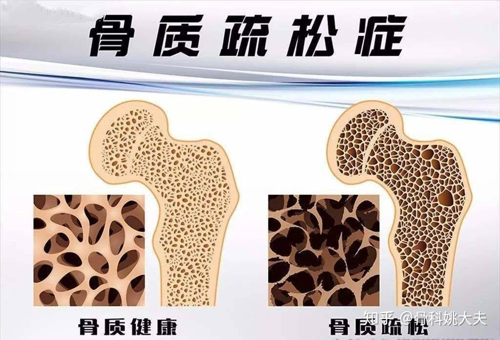 女性50岁后骨质疏松发病率高牢记5条调理秘诀强健骨骼身体好
