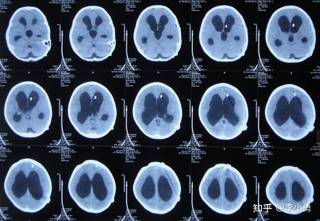 脑膜炎性脑积水4家医院8次住院3次手术三室造瘘脑室腹腔分流和脑室