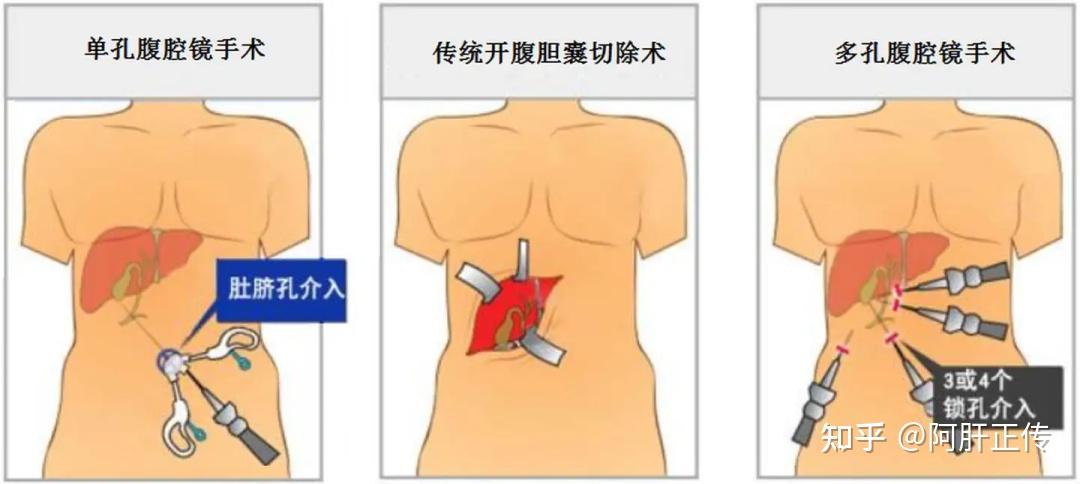 单孔腹腔镜手术，传统开腹手术，多孔腹腔镜手术