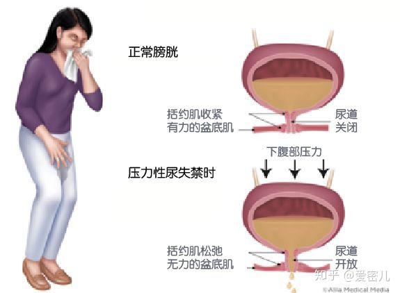 爱密儿：女性“漏尿”问题不该得过且过 - 知乎