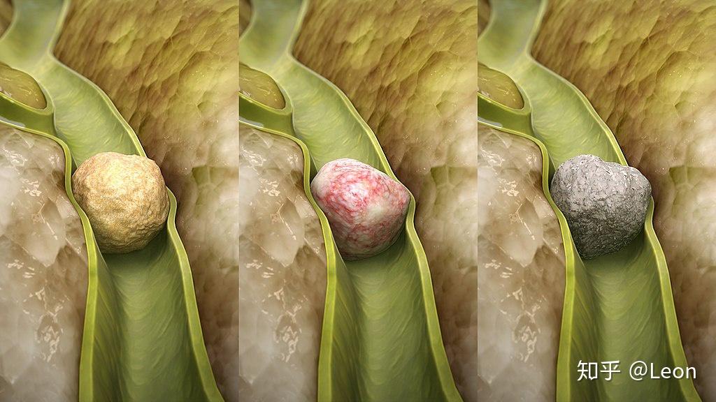 胆石症 Gallstones 胆结石 - 知乎