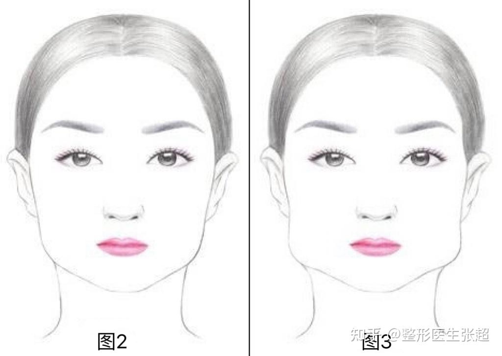 【超哥谈轮廓】颧骨宽下颌角大，预算有限先做哪个好？ - 知乎