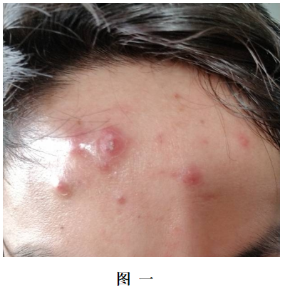 红肿发硬有按压痛的痘痘(没有脓头,就单纯的肿着不冒头)该怎么办?