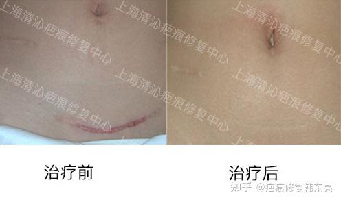 剖腹产疤痕你想问的全在这儿了,必看! - 知乎