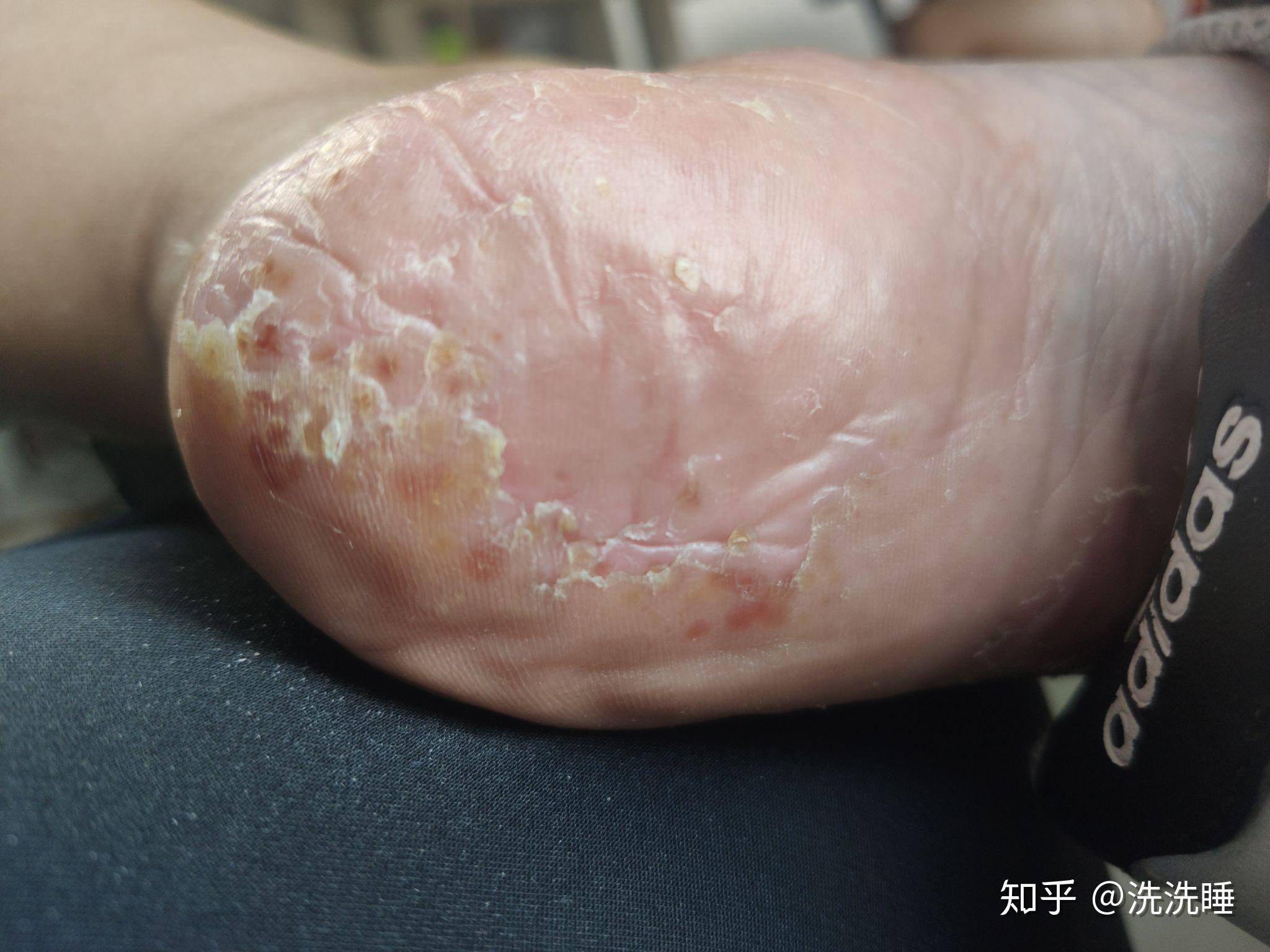 掌趾脓疱病治疗记录