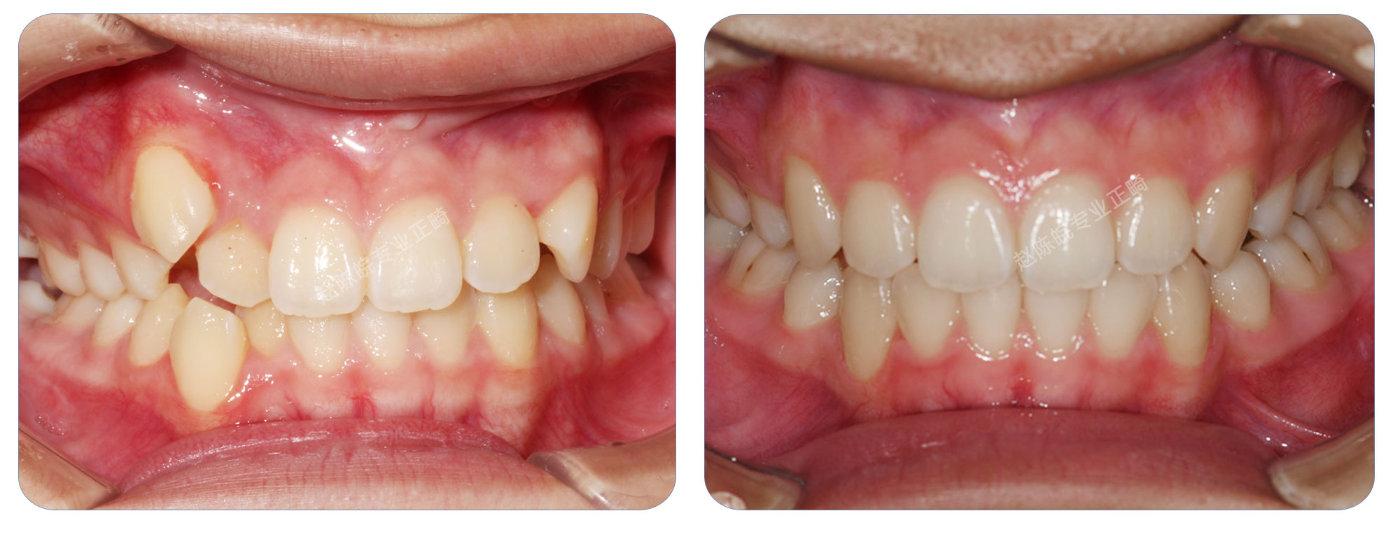 牙齿矫正效果 对比图片