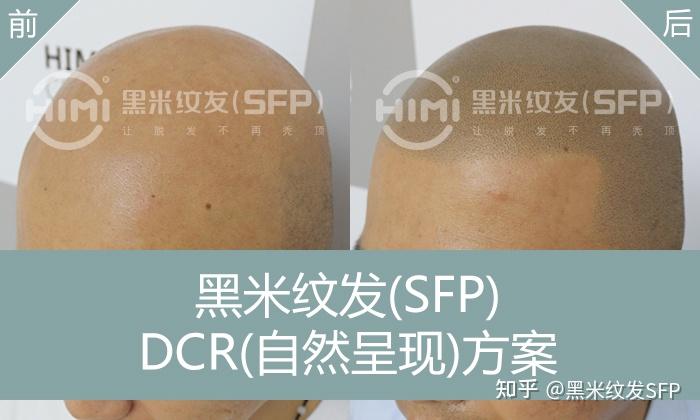 纹发全解：从原理到效果，一文读懂纹发的奥秘 - 知乎