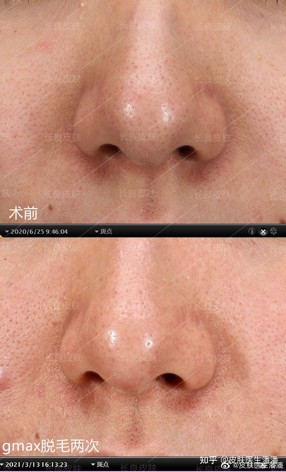 诊间笔记:严重的小棘状毛壅病