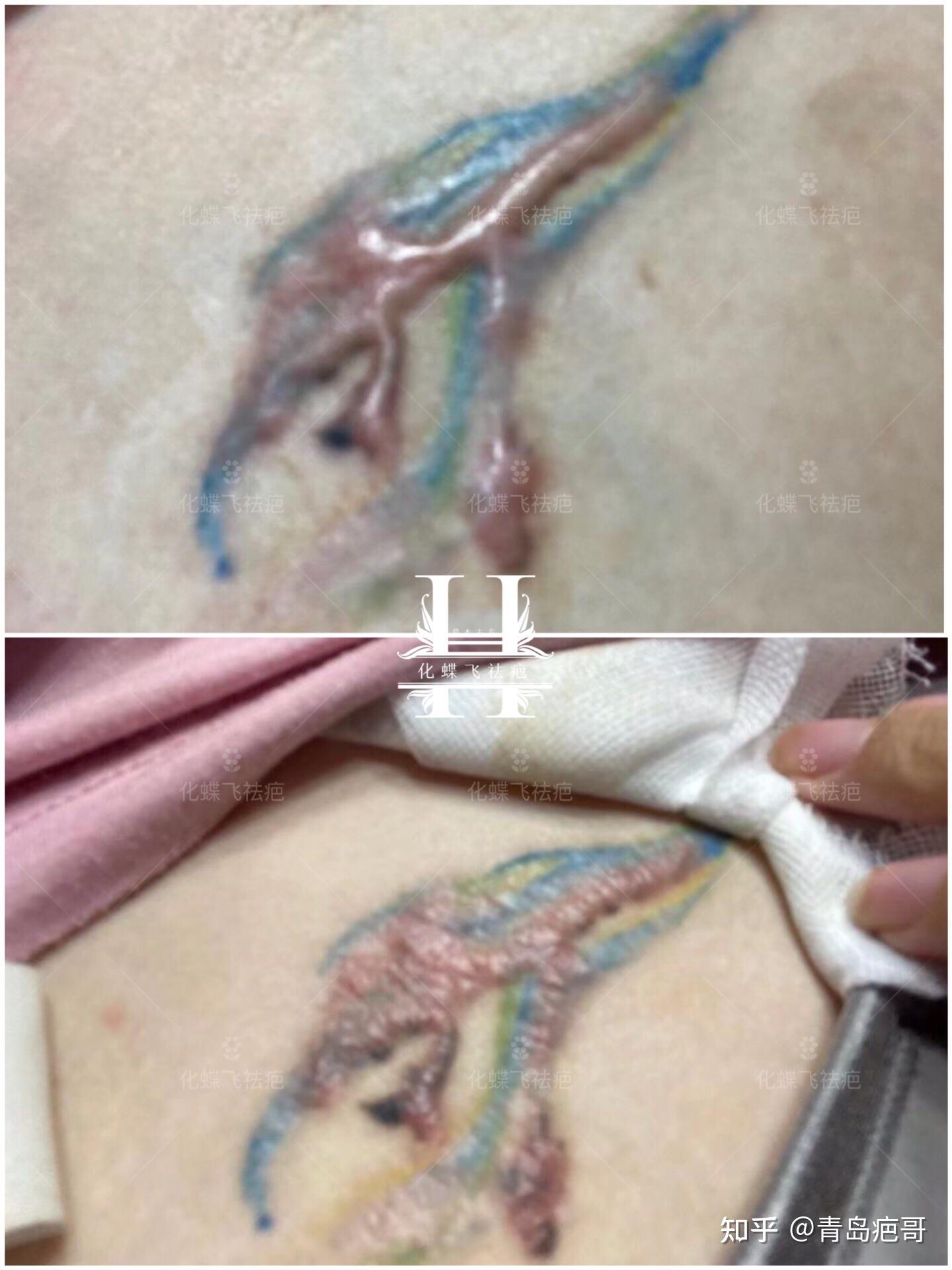 中国天津,洗纹身的增生疤痕.疤痕体质,同时又在孕期,疤痕增生很严重.